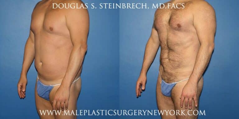 270 Torso tuck for abdominal sculpting by Dr. Steinbrech