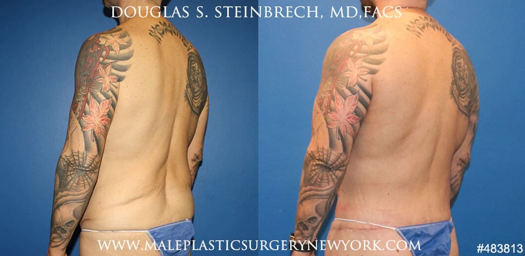 360 Torso tuck with body banking by Dr. Steinbrech