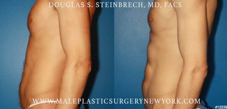 Abdominal implants for body scultping by Dr. Steinbrech