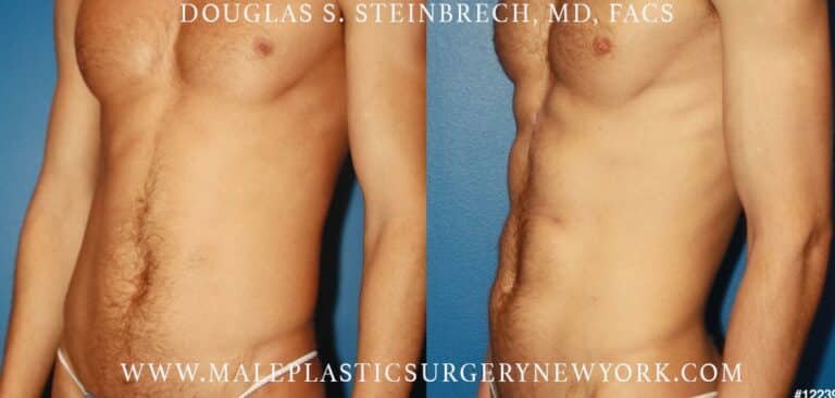 Abdominal implants for body scultping by Dr. Steinbrech