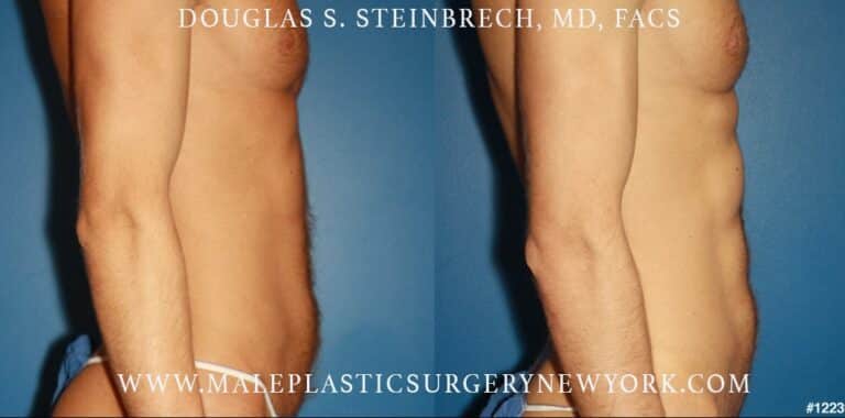 Abdominal implants for body scultping by Dr. Steinbrech