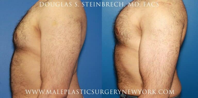 Bicep implants for upper arm augmentation by Dr. Steinbrech