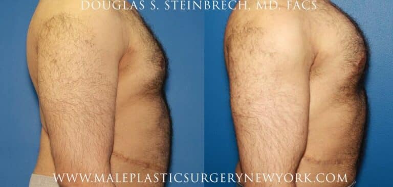 Bicep implants for upper arm augmentation by Dr. Steinbrech