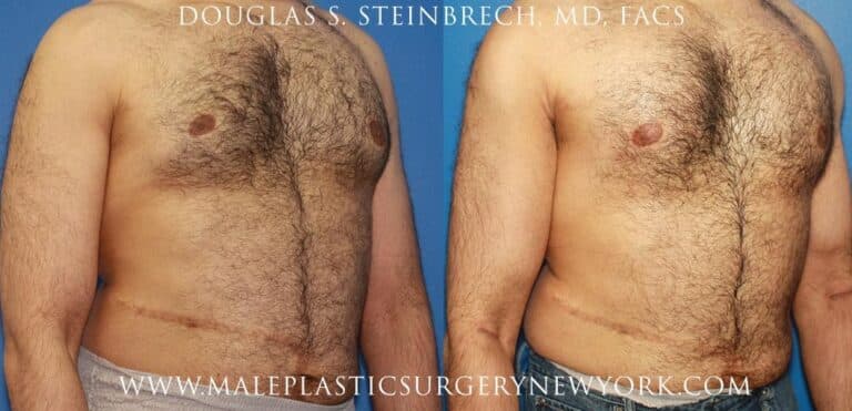 Bicep implants for upper arm augmentation by Dr. Steinbrech