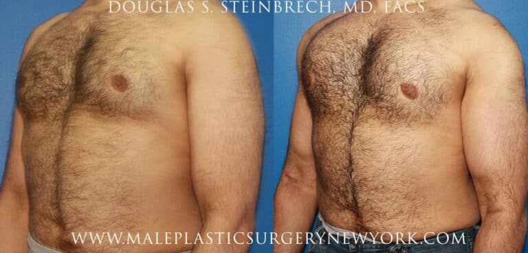 Bicep implants for upper arm augmentation by Dr. Steinbrech