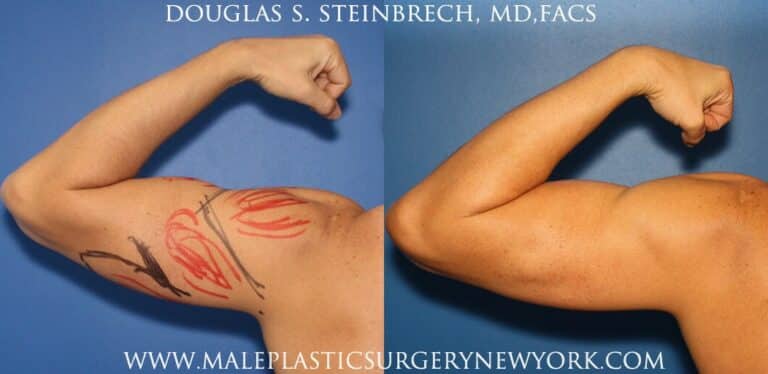 Bicep implants for upper arm augmentation by Dr. Steinbrech