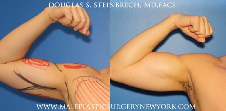 Bicep implants for upper arm augmentation by Dr. Steinbrech