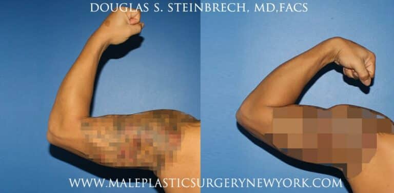 Bicep implants for upper arm augmentation by Dr. Steinbrech