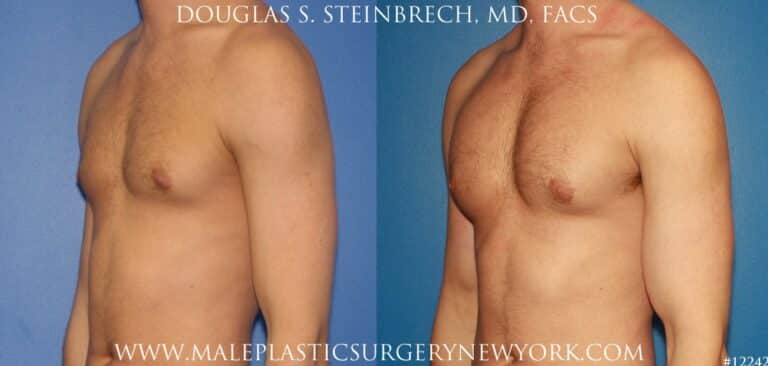 Bicep implants to augment the upper arm by Dr. Steinbrech