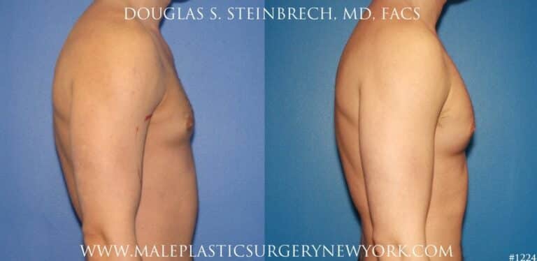 Bicep implants to augment the upper arm by Dr. Steinbrech