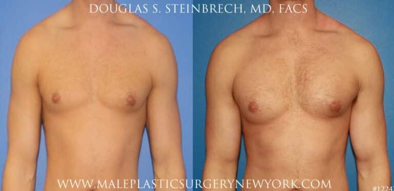 Bicep implants to augment the upper arm by Dr. Steinbrech