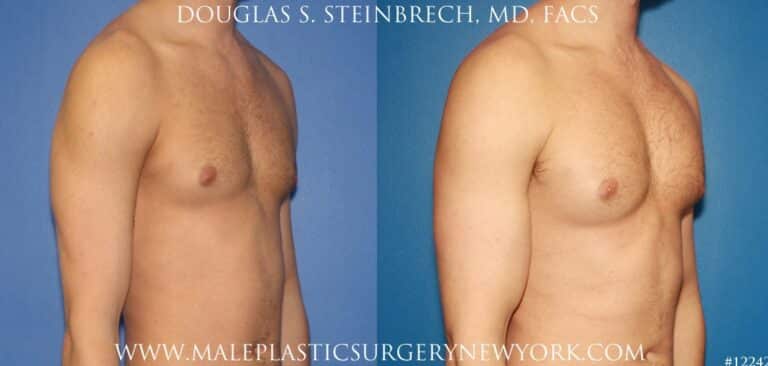 Bicep implants to augment the upper arm by Dr. Steinbrech