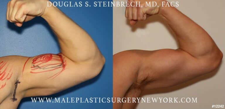 Bicep implants to augment the upper arm by Dr. Steinbrech
