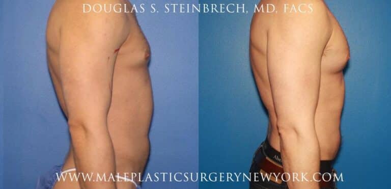Pectoral and bicep implants for chest augmentation by Dr. Steinbrech