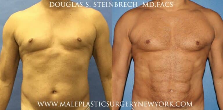 Body banking for contouring the upper body by Dr. Steinbrech