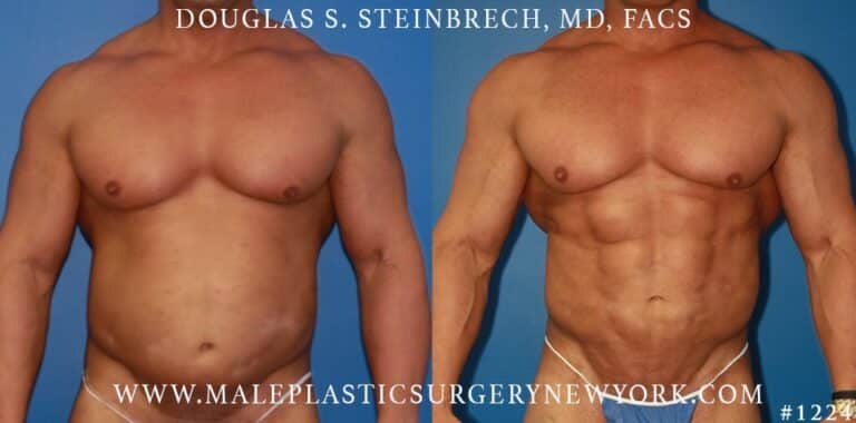 Gladiator abs and body banking by Dr. Steinbrech