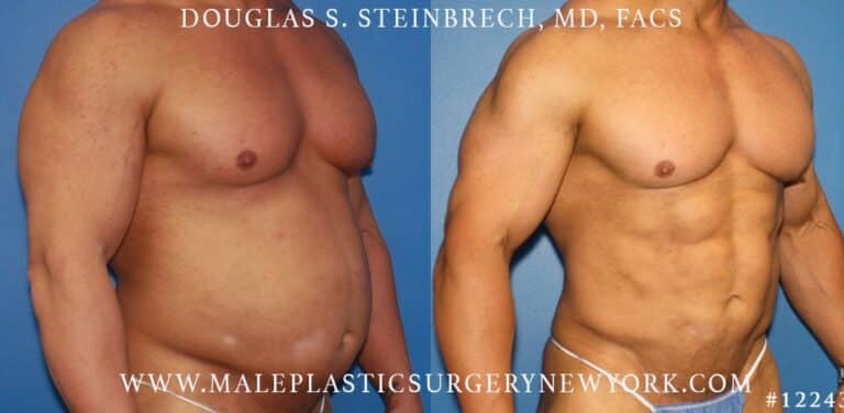 Gladiator abs and body banking by Dr. Steinbrech