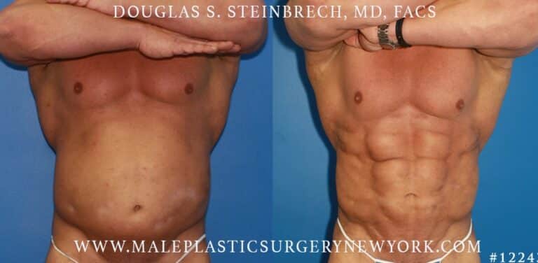 Gladiator abs and body banking by Dr. Steinbrech