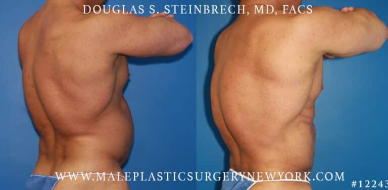 Gladiator abs and body banking by Dr. Steinbrech