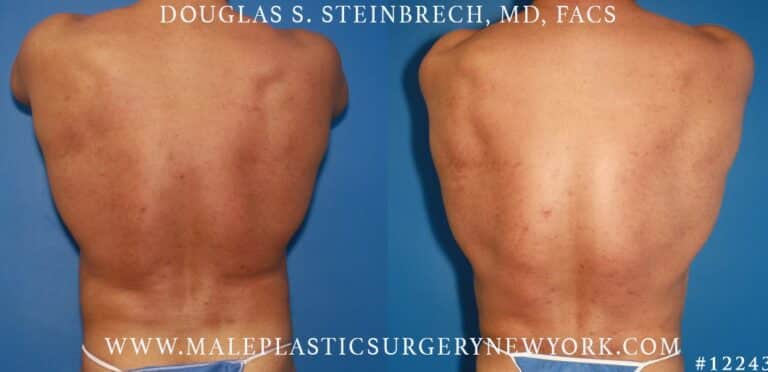 Gladiator abs and body banking by Dr. Steinbrech