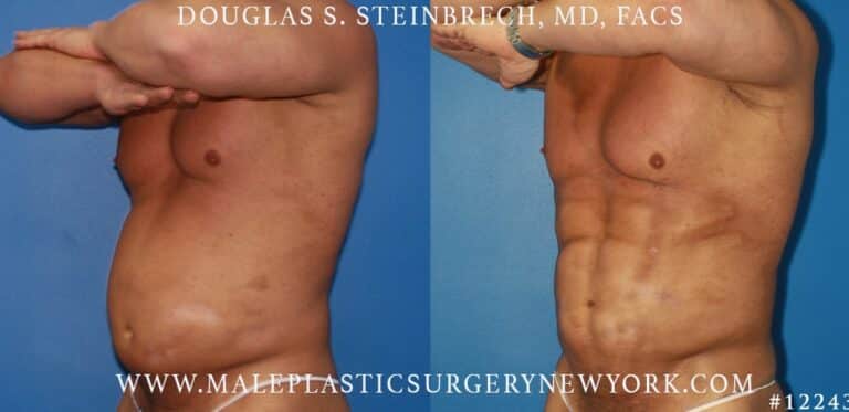 Gladiator abs and body banking by Dr. Steinbrech