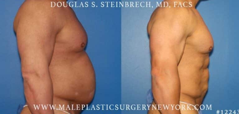 Gladiator abs and body banking by Dr. Steinbrech