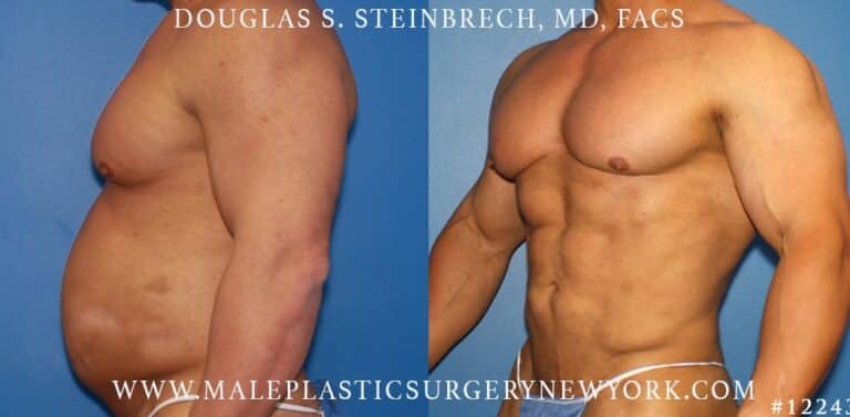 Gladiator abs and body banking by Dr. Steinbrech