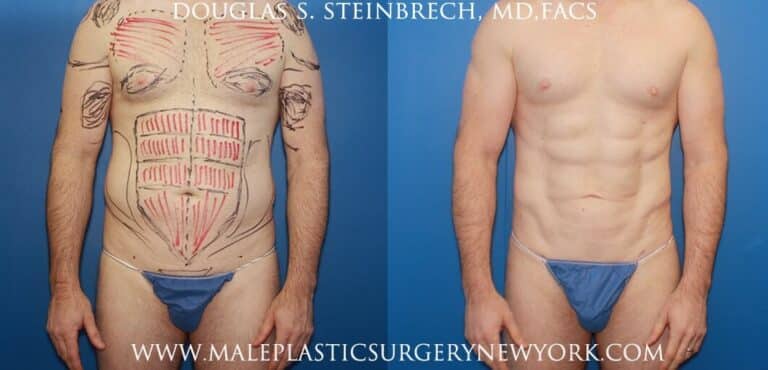 Body banking with fat transfer for body contouring and bicep augmentation by Dr. Steinbrech