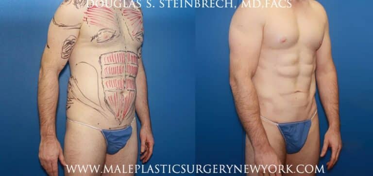 Body banking with fat transfer for body contouring and bicep augmentation by Dr. Steinbrech