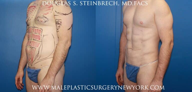 Body banking with fat transfer for body contouring and bicep augmentation by Dr. Steinbrech