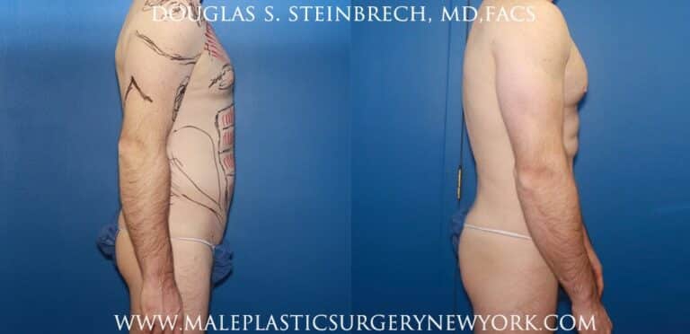 Body banking with fat transfer for body contouring and bicep augmentation by Dr. Steinbrech