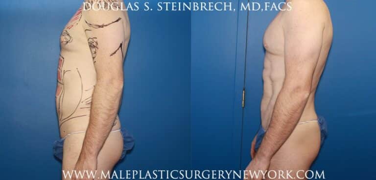 Body banking with fat transfer for body contouring and bicep augmentation by Dr. Steinbrech