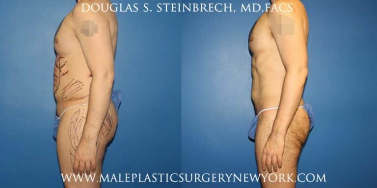 Body banking with gluteal augmentation by Dr. Steinbrech