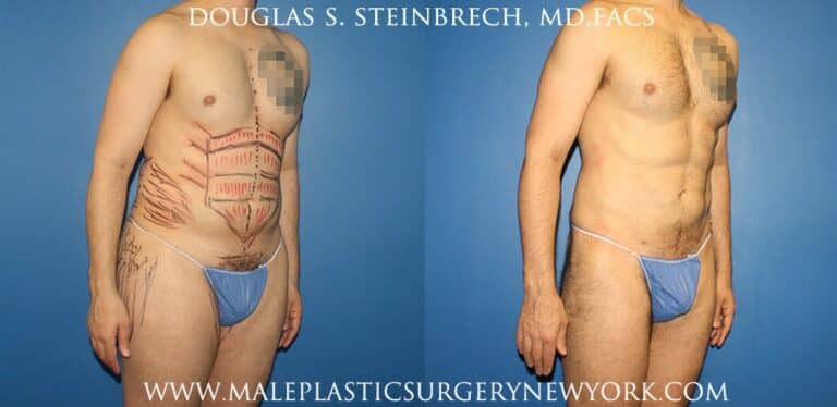 Body banking with gluteal augmentation by Dr. Steinbrech
