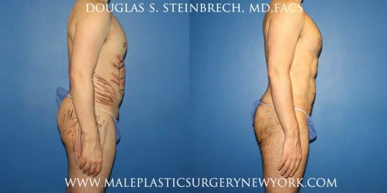 Body banking with gluteal augmentation by Dr. Steinbrech
