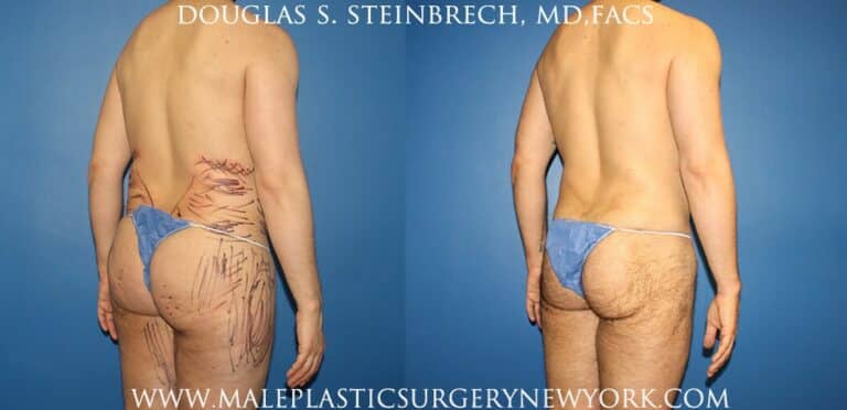 Body banking with gluteal augmentation by Dr. Steinbrech