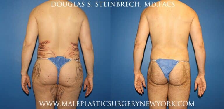 Body banking with gluteal augmentation by Dr. Steinbrech