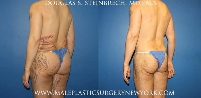 Body banking with gluteal augmentation by Dr. Steinbrech