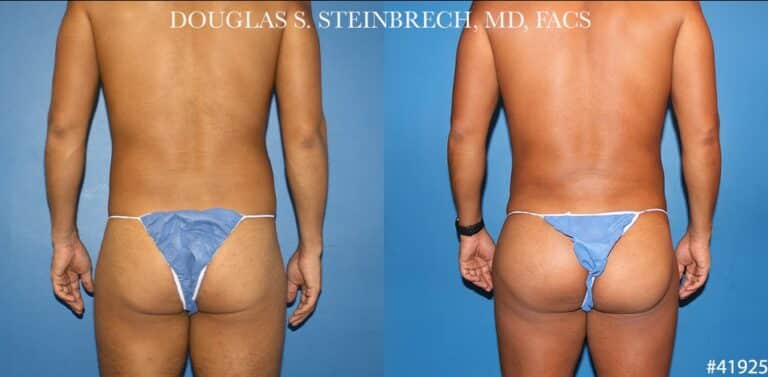 Body banking with gluteal implants for buttock enhancement by Dr. Steinbrech