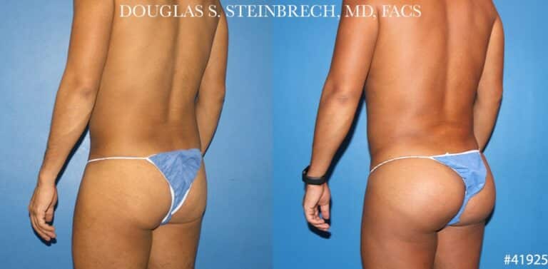 Body banking with gluteal implants for buttock enhancement by Dr. Steinbrech