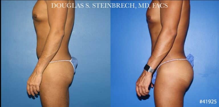 Body banking with gluteal implants for buttock enhancement by Dr. Steinbrech