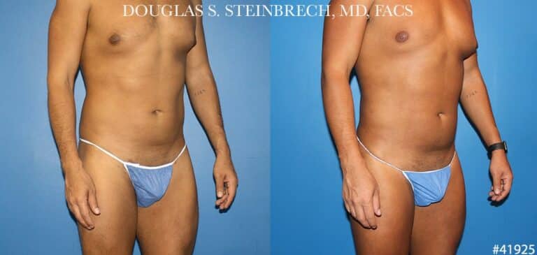 Body banking with gluteal implants for buttock enhancement by Dr. Steinbrech