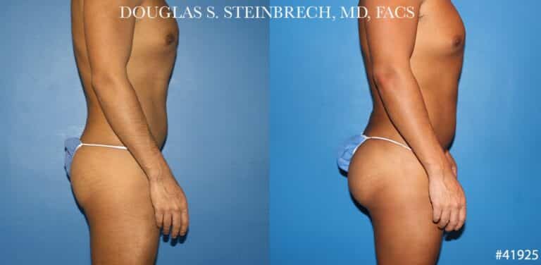 Body banking with gluteal implants for buttock enhancement by Dr. Steinbrech