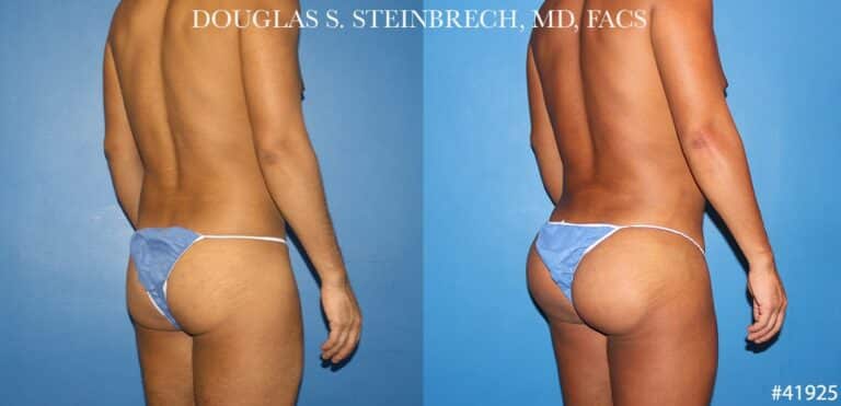 Body banking with gluteal implants for buttock enhancement by Dr. Steinbrech