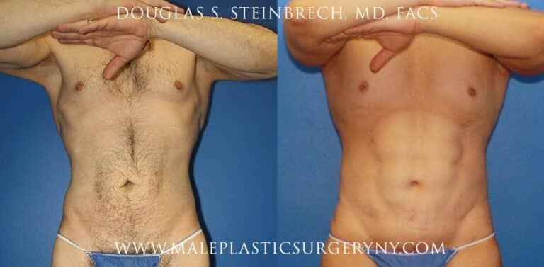 Body lift for upper body contouring by Dr. Steinbrech