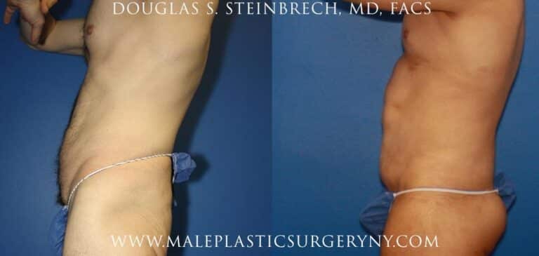 Body lift for upper body contouring by Dr. Steinbrech