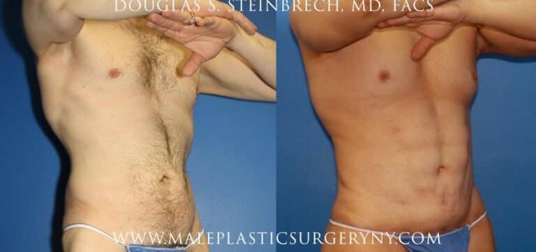 Body lift for upper body contouring by Dr. Steinbrech