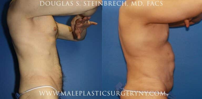 Body lift for upper body contouring by Dr. Steinbrech