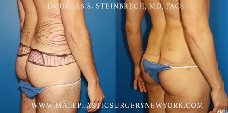 Body lift to enhance the buttocks by Dr. Steinbrech