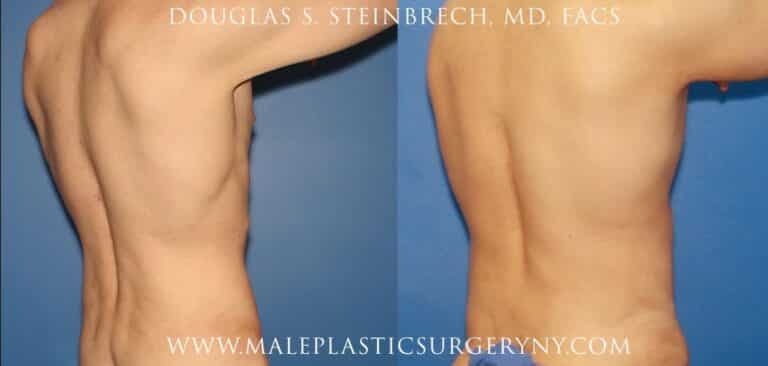 Body lift for sculpting the torso by Dr. Steinbrech